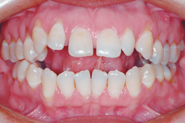 01_artigo_OrtodontiaSPO-v55n1 Oclusograma digital